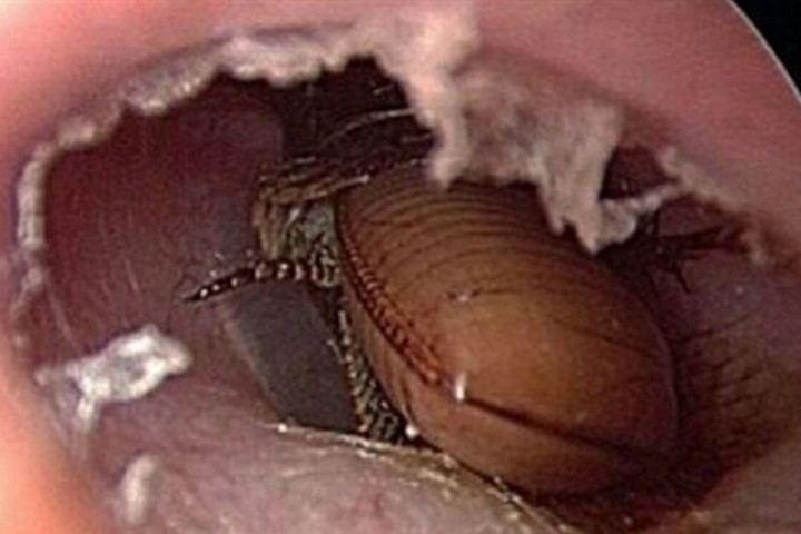 Bị gián chui vào tai, thay vì đi khám, người đàn ông lại "tự xử" bằng thuốc diệt côn trùng