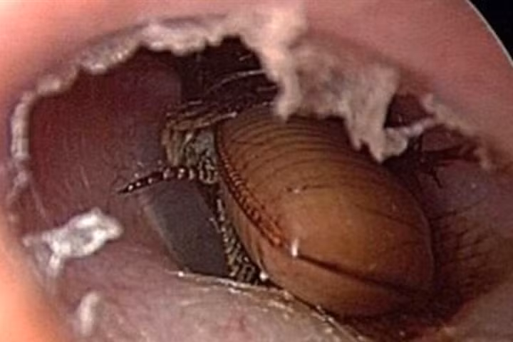 Bị gián chui vào tai, thay vì đi khám, người đàn ông lại "tự xử" bằng thuốc diệt côn trùng