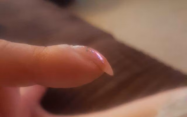 Ngón tay xuất hiện những dấu hiệu này có thể bạn mắc ung thư phổi