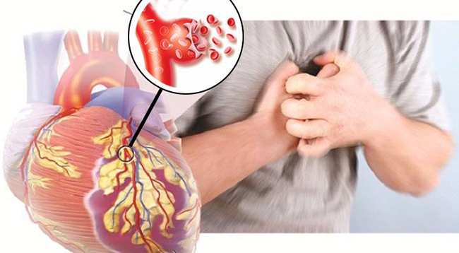 Bạn có thuộc 10 người dễ bị đột quỵ này không?