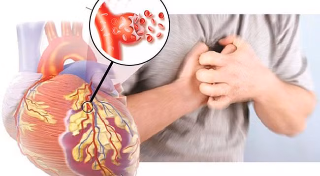 Bạn có thuộc 10 người dễ bị đột quỵ này không?
