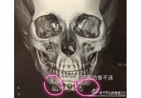 Di phau thuat de co cam V-line, co gai bi bac si cuong hiep hai lan - Anh 3