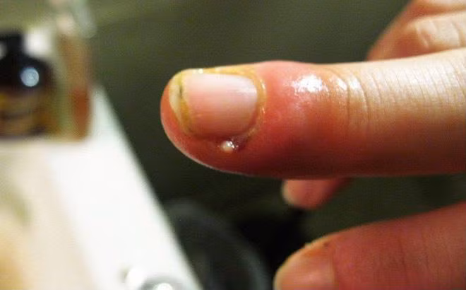 Xước măng rô: Ghi nhớ ngay cách xử lý đơn giản này kẻo hoại tử cả ngón tay ảnh 4