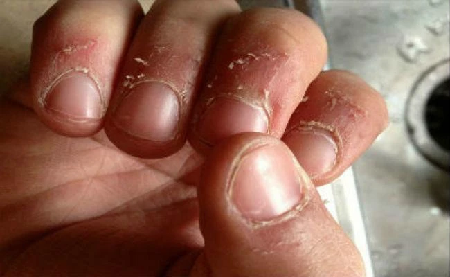 Xước măng rô là một hiện tượng có thể xảy ra ở mọi đối tượng - Ảnh minh họa: Internet