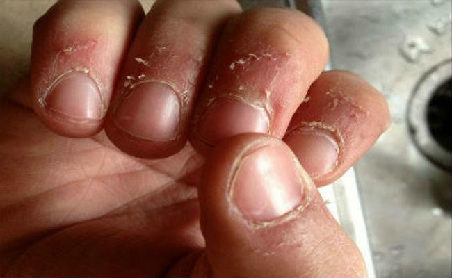 Xước măng rô là một hiện tượng có thể xảy ra ở mọi đối tượng - Ảnh minh họa: Internet