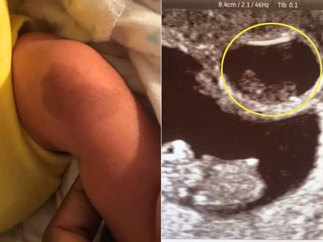 Mang thai đôi nhận tin “sét đánh”, mẹ nhìn chân con trai vừa chào đời mà sững sờ