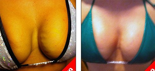 Vòng 1 trước khi nâng ngực bằng phương pháp mới