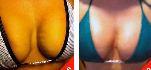 Vòng 1 trước khi nâng ngực bằng phương pháp mới