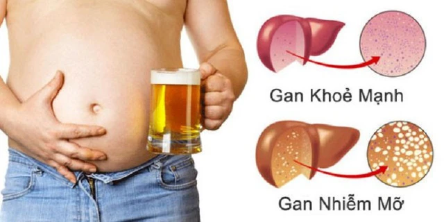 Dấu hiệu gan nhiễm mỡ, nên đi khám ngay khi phát hiện