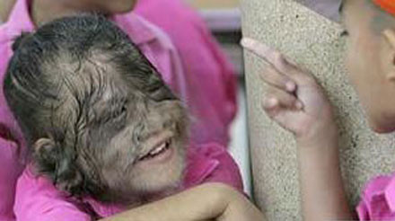 10 căn bệnh đáng sợ trong lịch sử loài người - Ảnh 8 10 căn bệnh đáng sợ trong lịch sử loài người - Ảnh 8