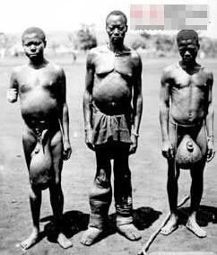 10 căn bệnh đáng sợ trong lịch sử loài người - Ảnh 9 10 căn bệnh đáng sợ trong lịch sử loài người - Ảnh 9