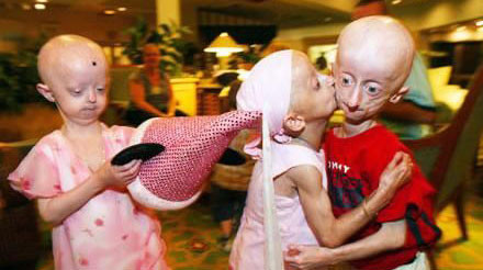 10 căn bệnh đáng sợ trong lịch sử loài người - Ảnh 10 10 căn bệnh đáng sợ trong lịch sử loài người - Ảnh 10