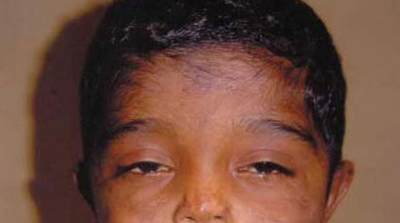 10 căn bệnh đáng sợ trong lịch sử loài người - Ảnh 2 10 căn bệnh đáng sợ trong lịch sử loài người - Ảnh 2