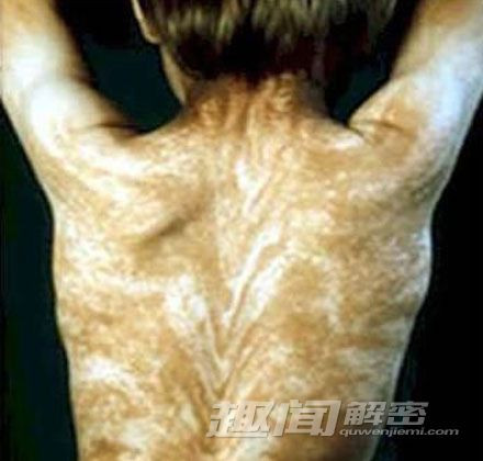 10 căn bệnh đáng sợ trong lịch sử loài người - Ảnh 4 10 căn bệnh đáng sợ trong lịch sử loài người - Ảnh 4