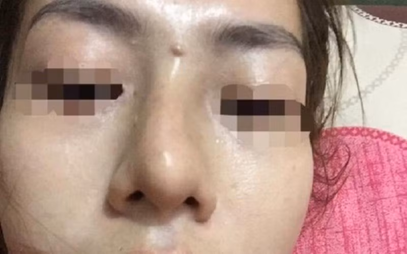 Bé gái 13 tuổi biến chứng sau tiêm filler.
