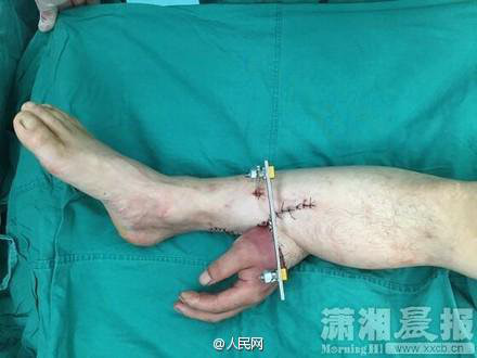Ca cấy ghép hi hữu bàn tay được nuôi dưỡng trên chân - Ảnh 1 Ca cay ghep hi huu ban tay duoc nuoi duong tren chan - Anh 1