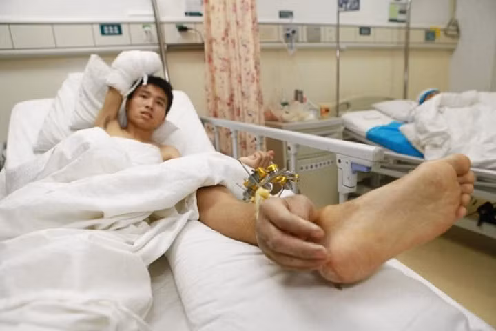 Ca cấy ghép hi hữu bàn tay được nuôi dưỡng trên chân