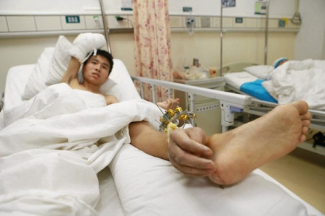 Ca cấy ghép hi hữu bàn tay được nuôi dưỡng trên chân - Ảnh 2 Ca cay ghep hi huu ban tay duoc nuoi duong tren chan - Anh 2