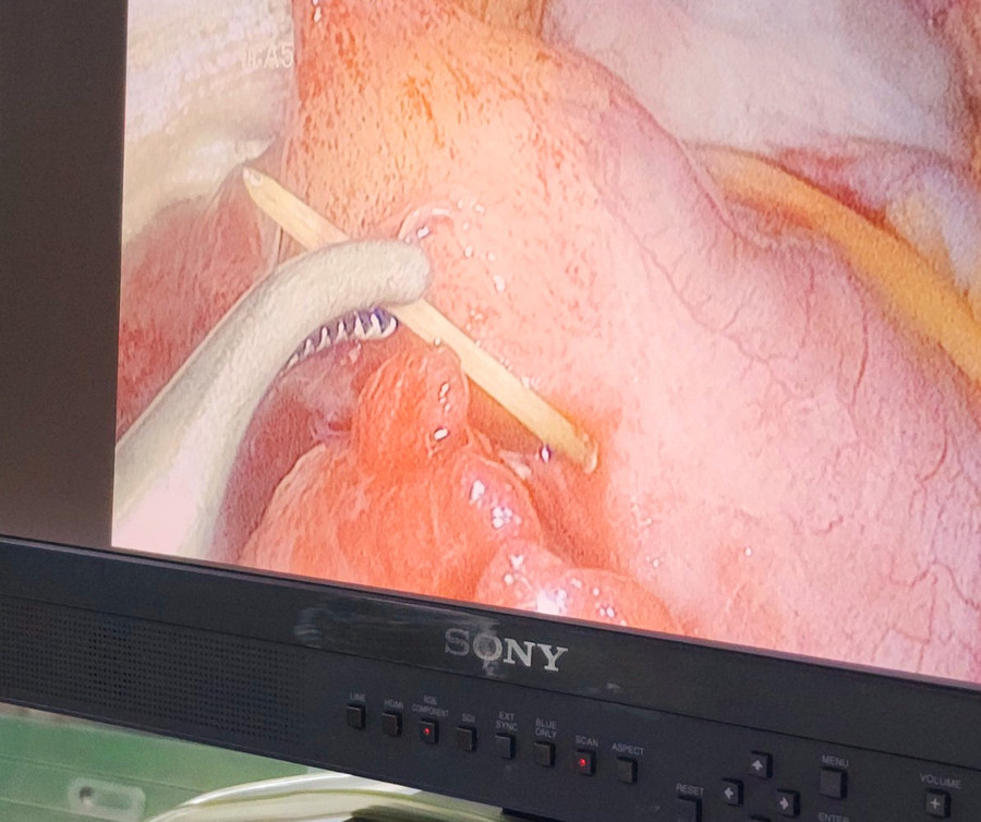 Phẫu thuật nội soi lấy dị vật khỏi bụng bệnh nhân. Phẫu thuật nội soi lấy dị vật khỏi bụng bệnh nhân.