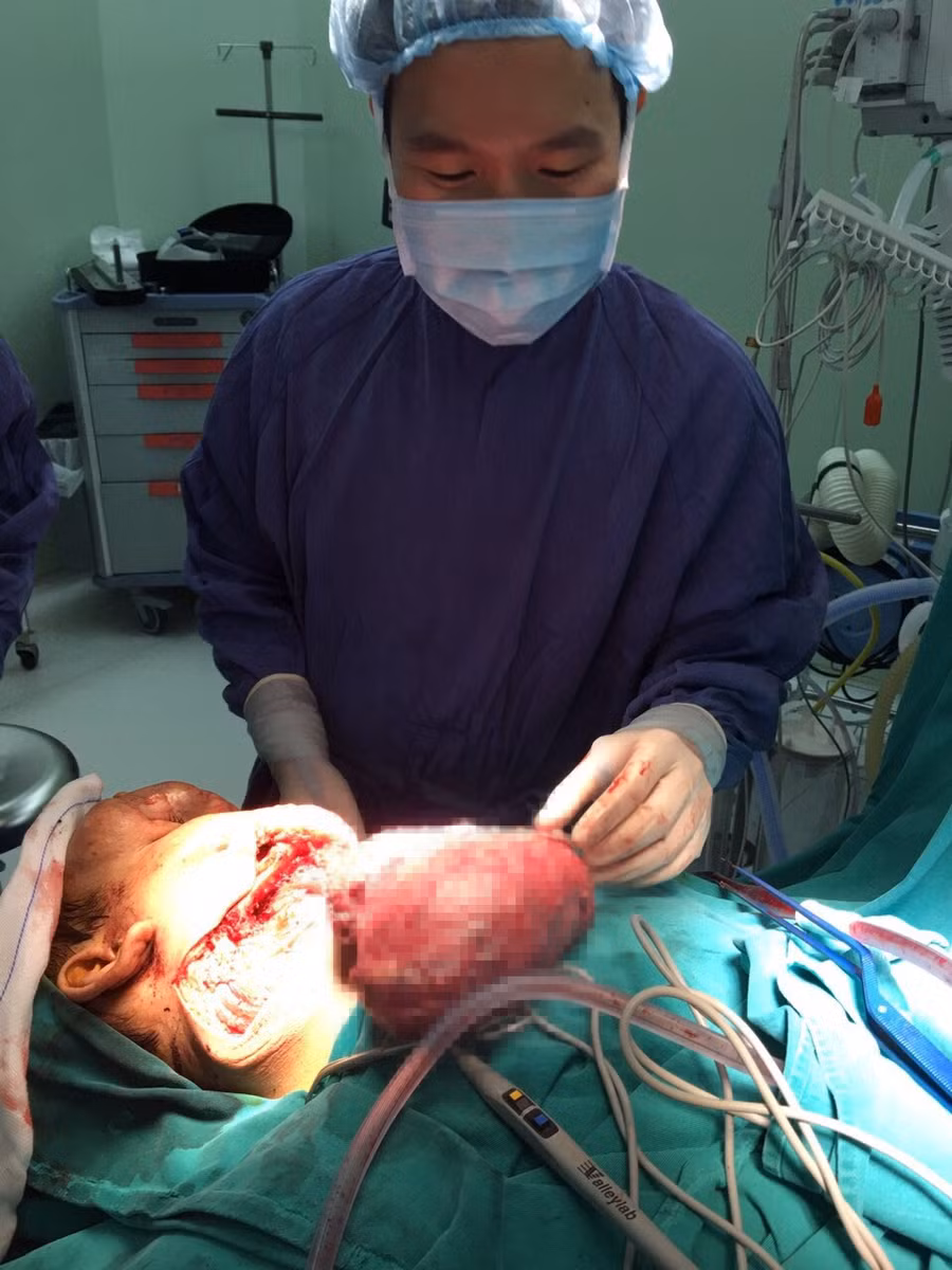 Ca mổ kỷ lục lấy lại gương mặt cho bệnh nhân mắc khối u ‘khủng’
