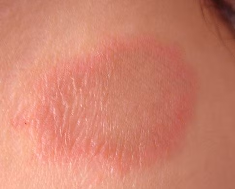 Làn da bạn bị tàn phá như thế nào khi thiếu ngủ?