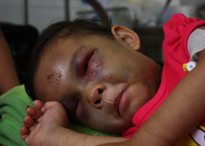 Bé Ngân bị ba mẹ đánh bầm tím hai mắt. Bé Ngân bị ba mẹ đánh bầm tím hai mắt.