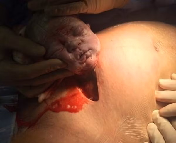 Cứ ngỡ sinh mổ là khỏe, xem những hình ảnh này mới thấu hiểu 