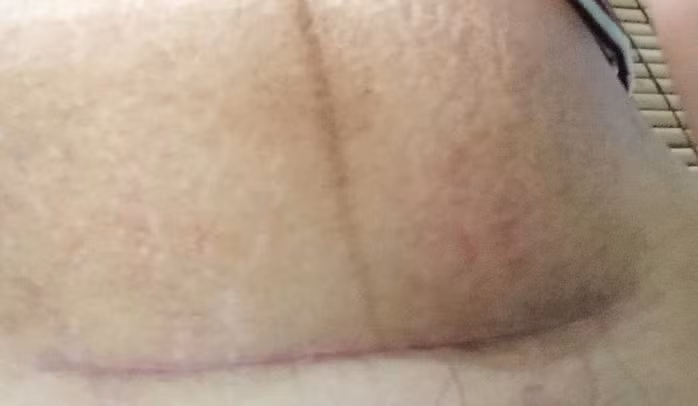 Cứ ngỡ sinh mổ là khỏe, xem những hình ảnh này mới thấu hiểu 