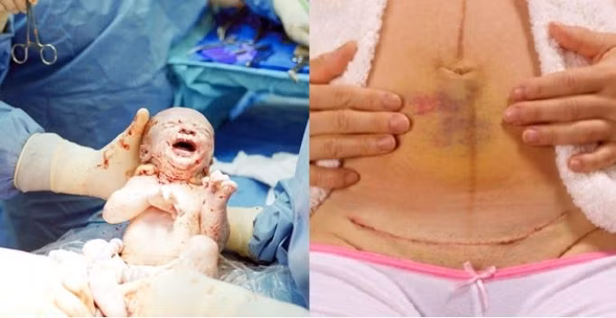 Cứ sinh mổ là khỏe, xem hình ảnh này mới thấy phụ nữ chịu khổ thế nào