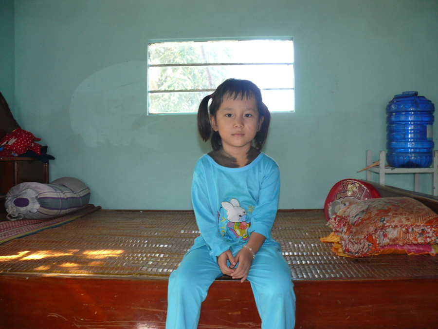 Trên cơ thể bé Ngọc Bích vẫn còn rất nhiều lông. Mong rằng các nhà hảo tâm mở rộng tấm lòng để giúp bé trị dứt điểm căn bệnh quái ác