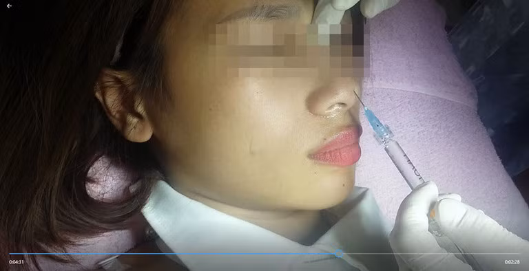 Tiêm filler giá 1,5 triệu đồng, bé gái 15 tuổi mù mắt