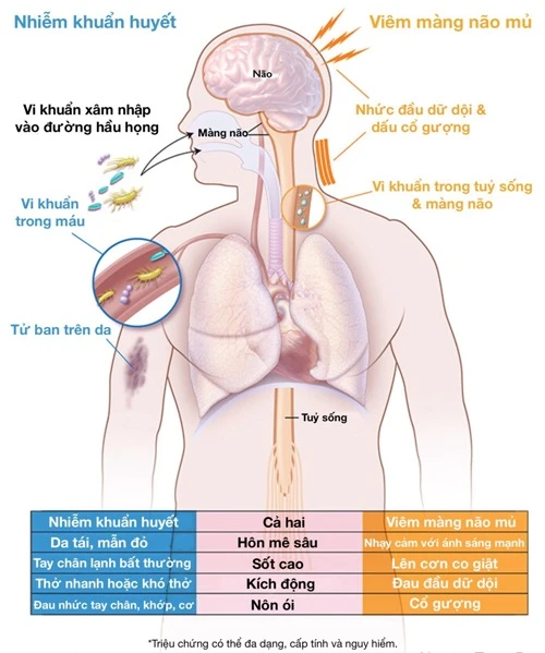 Dấu hiệu cảnh báo bệnh viêm não mô cầu