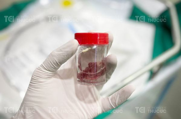 Khối polyp đại tràng 4cm được cắt bỏ qua nội soi khiến người bệnh không khỏi ngỡ ngàng (Ảnh: TCI) Khối polyp đại tràng 4cm được cắt bỏ qua nội soi khiến người bệnh không khỏi ngỡ ngàng (Ảnh: TCI)