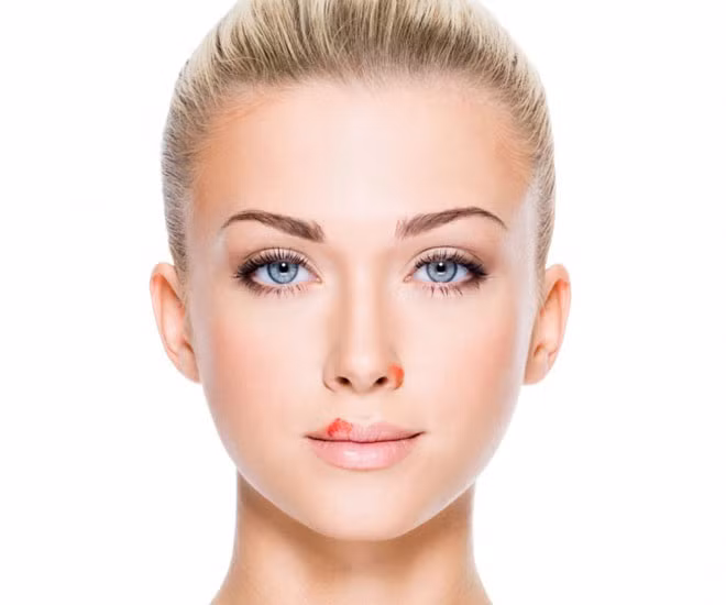 Các vết loét quanh môi và miệng xuất hiện có thể do virus herpes tuýp 1 gây ra. Khi hệ thống miễn dịch của bạn bị suy yếu vì căng thẳng, bệnh tật, hoặc mệt mỏi, virus này trong cơ thể sẽ có cơ hội bùng phát.