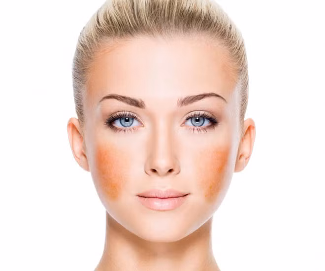 Nám da xuất hiện bởi một loại bệnh tăng sắc tố. Nó phổ biến hơn ở phụ nữ và phát triển nhanh hơn với người có làn da sẫm màu. Phơi nắng thường xuyên cũng kích thích sự phát triển sắc tố.