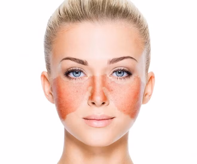 Phát ban hình cánh bướm báo hiệu bạn mắc bệnh lupus. Các triệu chứng khác của bệnh lupus là sốt, đau khớp và ngón tay trở nên xanh xao trong thời tiết giá lạnh.