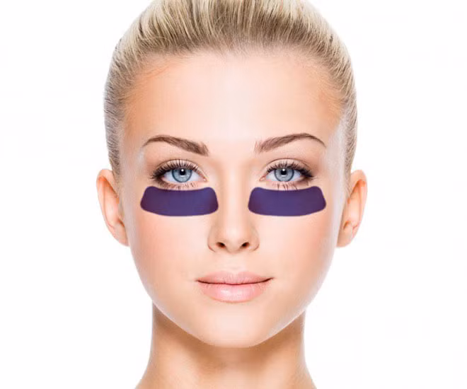 Quầng thâm và bọng mắt xuất hiện có thể do bạn thiếu ngủ, hút thuốc, thay đổi hormone, dị ứng hay lạm dụng rượu, cà phê và thực phẩm nhiều muối...