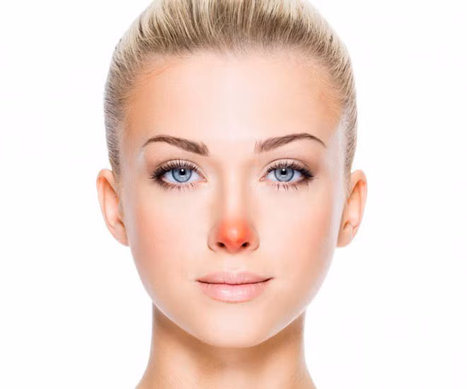 Mũi đỏ do sự thay đổi nhiệt độ, dị ứng, căng thẳng cảm xúc, hoặc sổ mũi. Tuy nhiên, nếu mũi của bạn luôn đỏ, hãy chú ý đến tình trạng của mạch máu, xem lại lối sống và gặp bác sĩ để được chẩn đoán cụ thể.