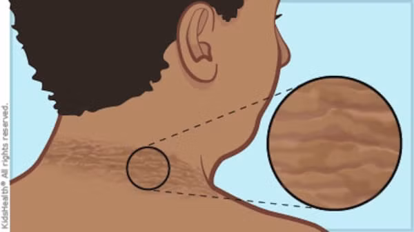 Có biểu hiện này sau cổ, bạn rất có thể đã mắc bệnh tiểu đường!