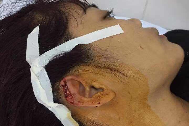 Giáo viên dạy khiêu vũ thể thao bị cắn đứt tai