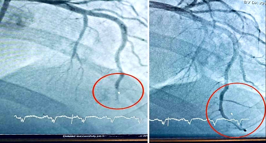 Hình ảnh vị trí tắc động mạch liên thất trước và sau can thiệp.
