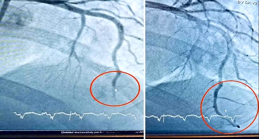 Hình ảnh vị trí tắc động mạch liên thất trước và sau can thiệp. Hình ảnh vị trí tắc động mạch liên thất trước và sau can thiệp.