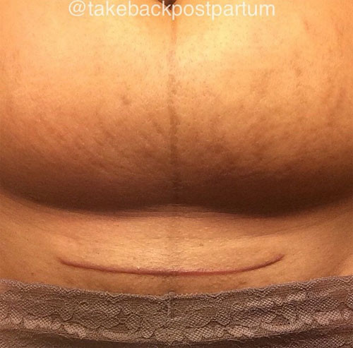 Thăm “nơi” các mẹ thỏa thuê khoe bụng phệ sau sinh - 8