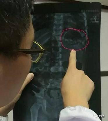 Nhầm hạt nhựa nở là kẹo, đôi vợ chồng Trung Quốc cho con gái 3 tuổi ăn hết 300 viên - Ảnh 2 Nham hat nhua no la keo, doi vo chong Trung Quoc cho con gai 3 tuoi an het 300 vien - Anh 2
