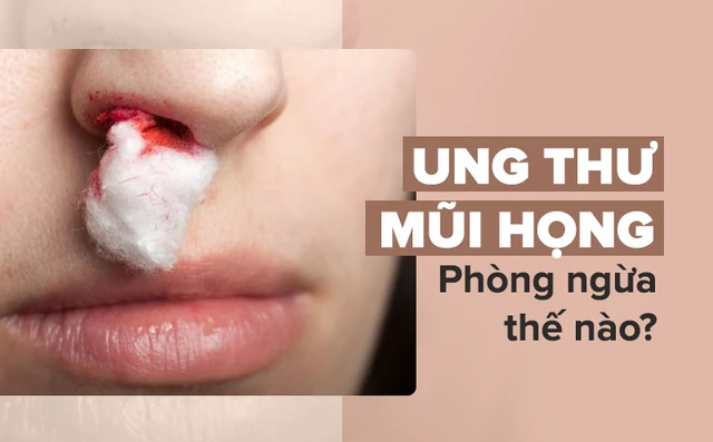 Đây là dấu hiệu sớm nhất của bệnh ung thư mũi họng: Cần nắm rõ để phòng bệnh kịp thời