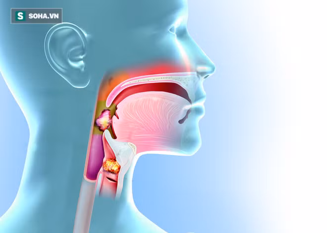 Đây là dấu hiệu sớm nhất của bệnh ung thư mũi họng: Cần nắm rõ để phòng bệnh kịp thời - Ảnh 1.