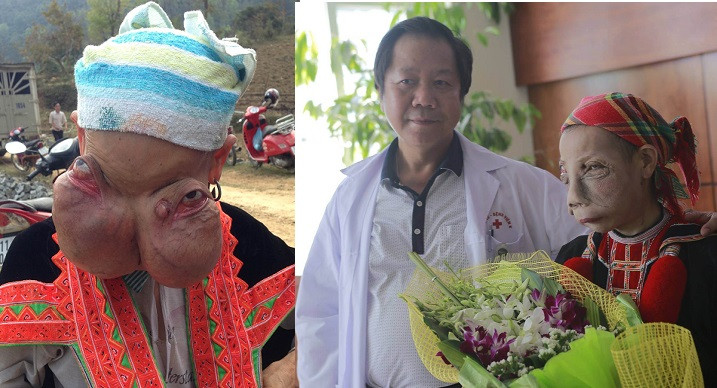 Chân dung chị Lý Mùi Xiên và khối u “mặt quỷ” trước và sau khi được phẫu thuật.