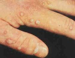 Thuốc trị mụn cóc ảnh 1 Thuốc trị mụn cóc