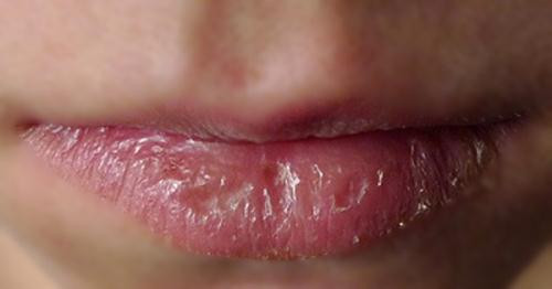 Môi khôcũng là một triệu chứng cho thấy bạn đang bị nóng trong người. Môi khô cũng là một triệu chứng cho thấy bạn đang bị nóng trong người