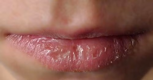 Môi khô cũng là một triệu chứng cho thấy bạn đang bị nóng trong người